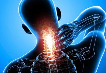 intensive Nackenschmerzen mit fortgeschrittener Osteochondrose