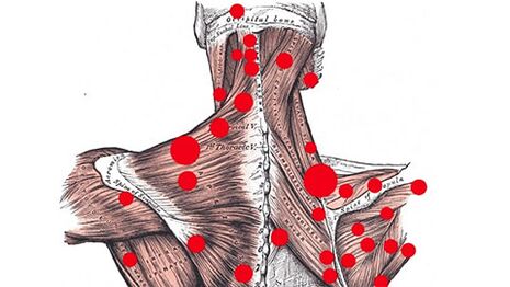 Triggerpunkte in Muskeln, die myofasziale Rückenschmerzen hervorrufen