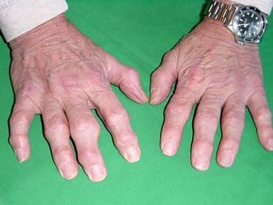 Arthrose der Finger