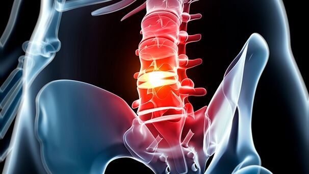Osteochondrose der Lendenwirbelsäule