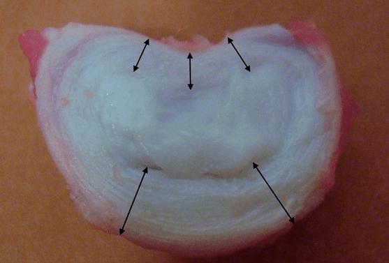 Wie sieht eine Bandscheibe aus