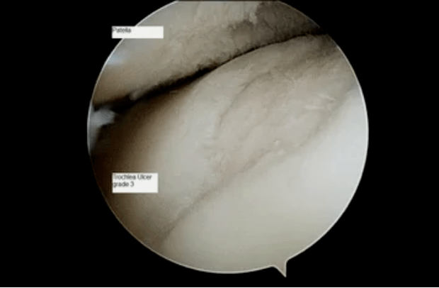 Astroskopische Ansicht eines Kniegelenks mit Arthrose 3. Grades